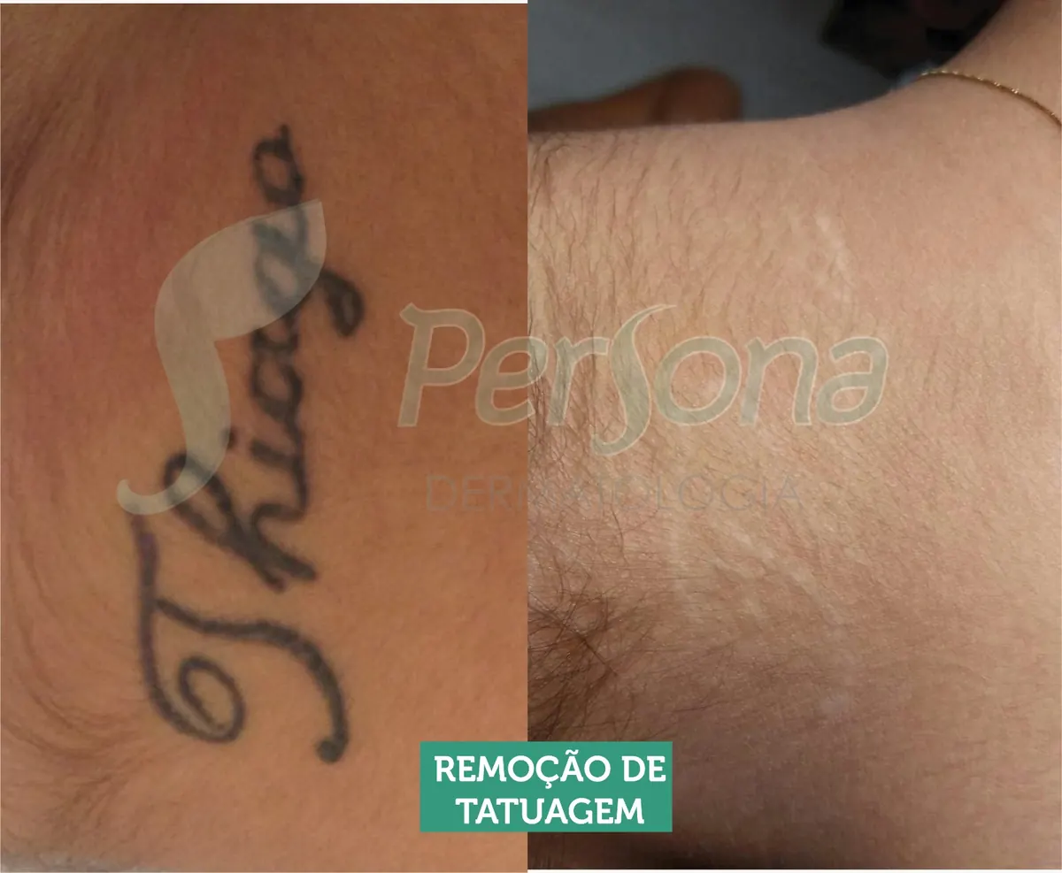 Antes e depois de remoção de tatuagem na Persona Dermatologia