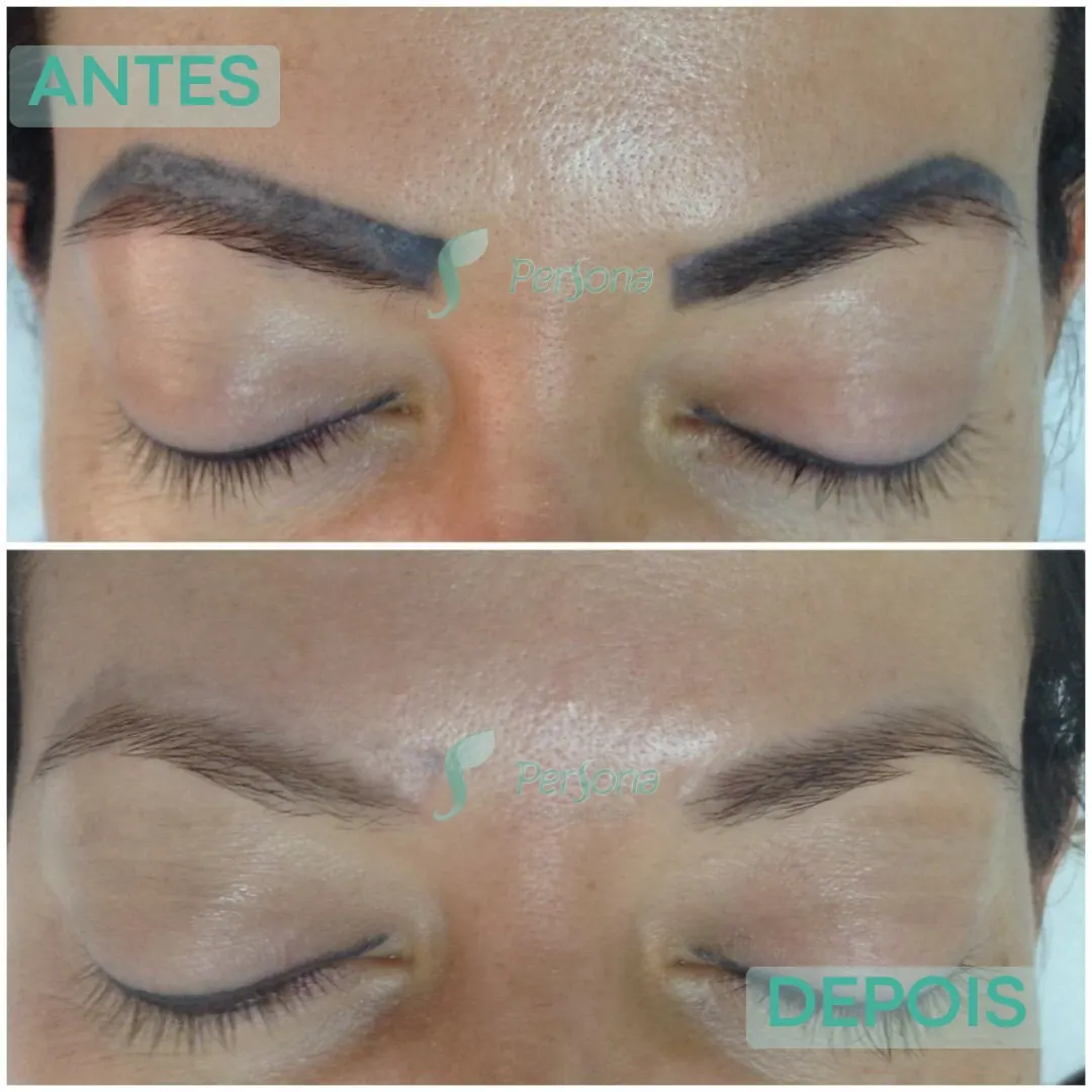 Antes e depois de remoção de tatuagem realizada na Persona Dermatologia