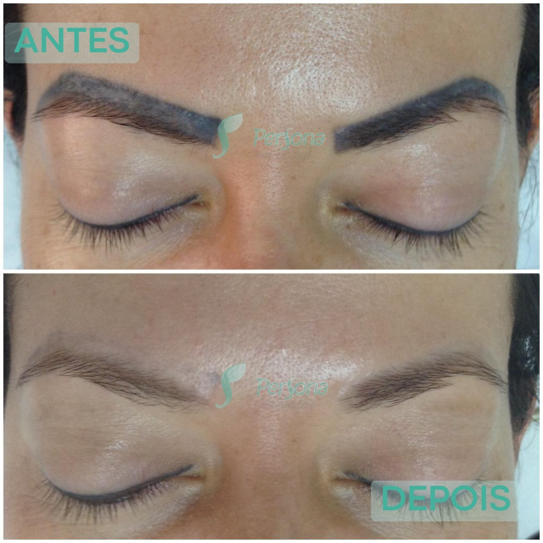 Antes e depois de remoção de tatuagem realizada na Persona Dermatologia
